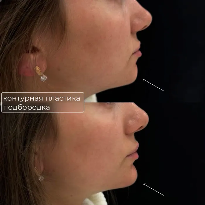 Контурная пластика