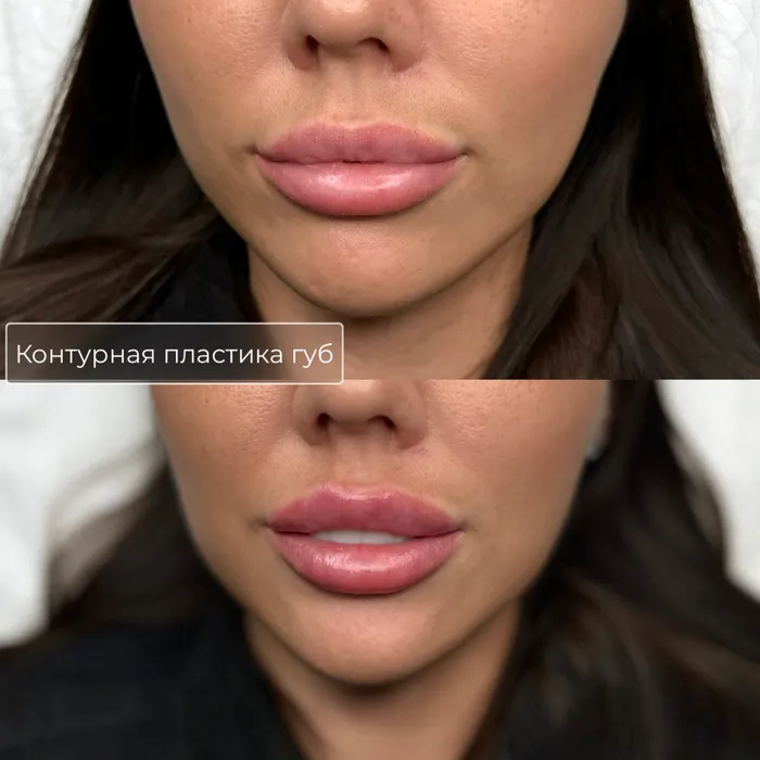 Увеличение и коррекция губ