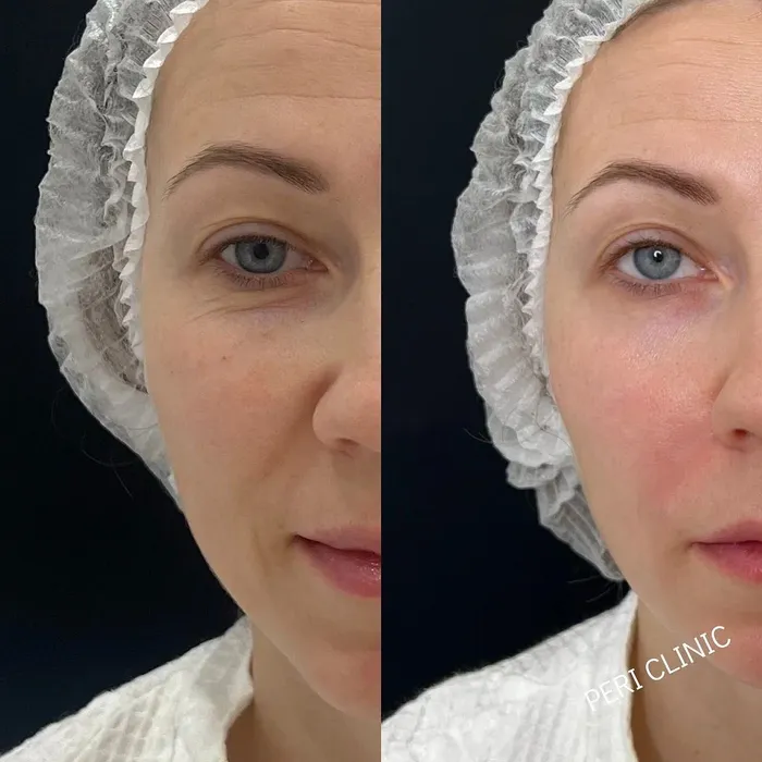 Контурная пластика Full Face — работа