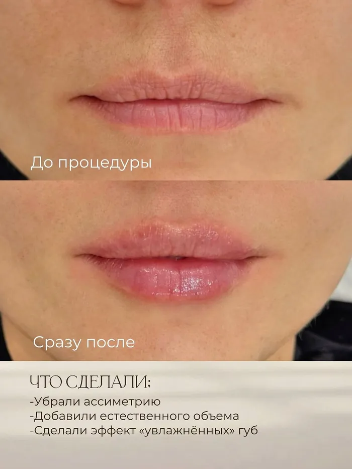 Контурная пластика губ — работа