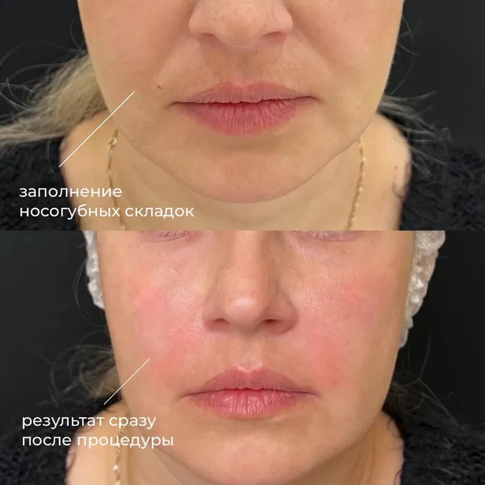 Контурная пластика лица — работа