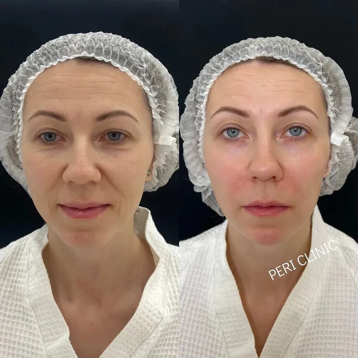 Контурная пластика Full Face — работа